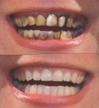 Complete Dentures before and After