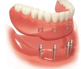 Implant Retained Dentures